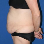 Other Post-Bariatric Procedures