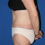 Other Post-Bariatric Procedures