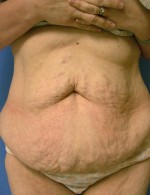 Other Post-Bariatric Procedures