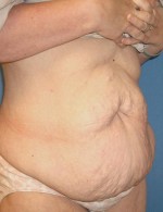 Other Post-Bariatric Procedures