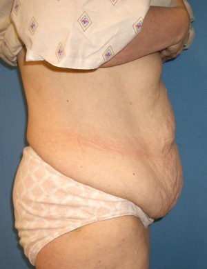 Other Post-Bariatric Procedures