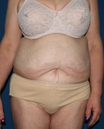 Other Post-Bariatric Procedures