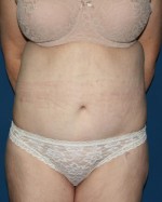 Other Post-Bariatric Procedures