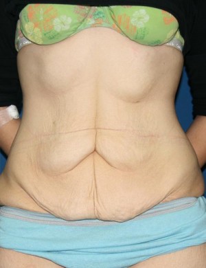 Other Post-Bariatric Procedures