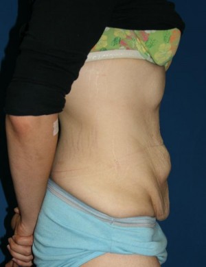 Other Post-Bariatric Procedures