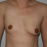 Congenital Breast Surgery