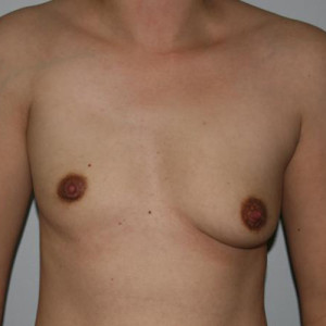 Congenital Breast Surgery