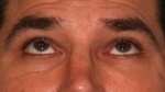 Eyelid Surgery