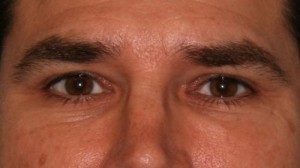 Eyelid Surgery