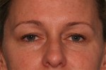 Eyelid Surgery