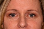 Eyelid Surgery