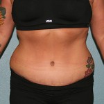 Tummy Tuck