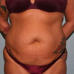 Tummy Tuck