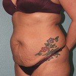 Tummy Tuck