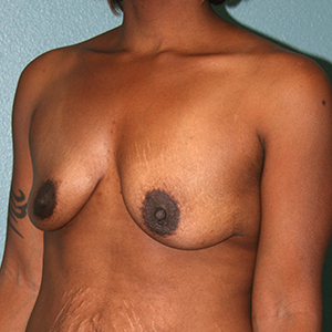 Breast Augmentation