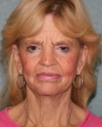 Face Lift