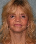 Face Lift