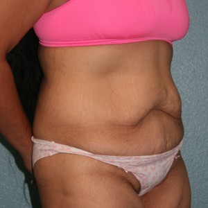 Tummy Tuck