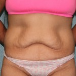 Tummy Tuck