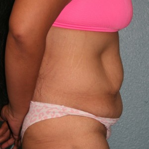 Tummy Tuck