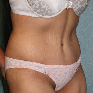 Tummy Tuck