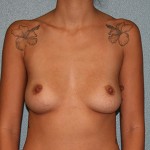 Breast Augmentation
