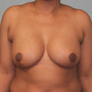 Breast Reduction