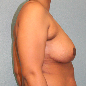 Breast Reduction