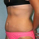 Tummy Tuck