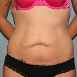 Tummy Tuck