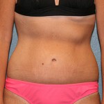 Tummy Tuck