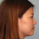 Nose Surgery (Rhinoplasty)