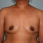 Breast Augmentation