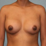 Breast Augmentation