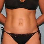 Tummy Tuck