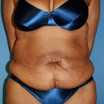 Tummy Tuck