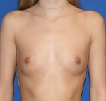 Breast Augmentation