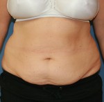 Tummy Tuck