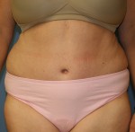 Tummy Tuck