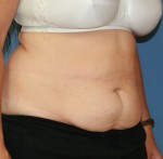 Tummy Tuck