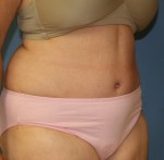 Tummy Tuck