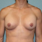Breast Augmentation
