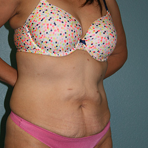 Tummy Tuck