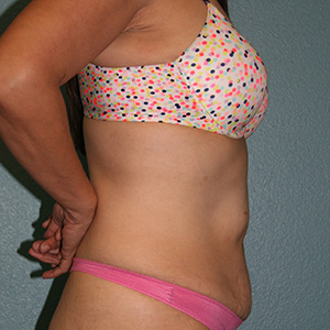 Tummy Tuck