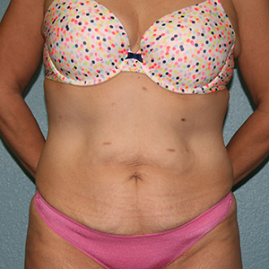 Tummy Tuck