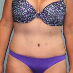 Tummy Tuck