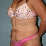 Tummy Tuck