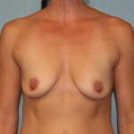 Breast Augmentation