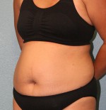 Tummy Tuck