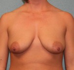 Breast Augmentation
